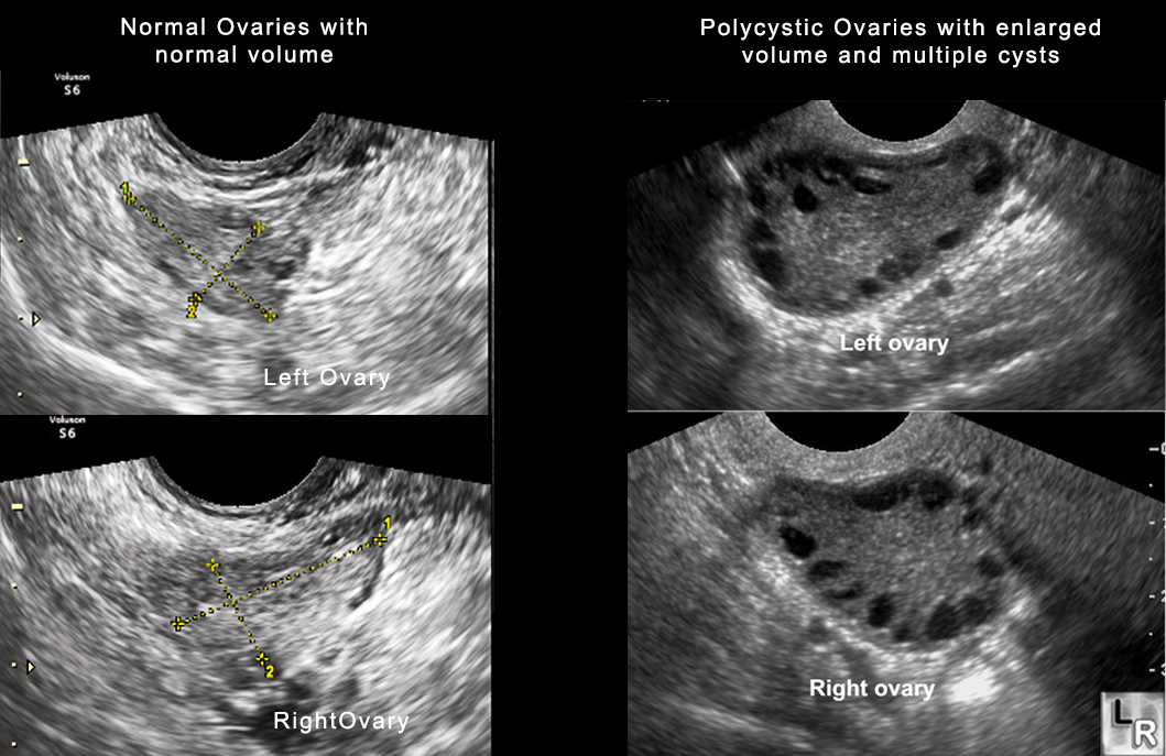 PCOS 1